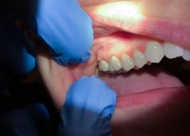 Best Emergency Dentist for Lost Fillings or Crowns in New Eagle, PA